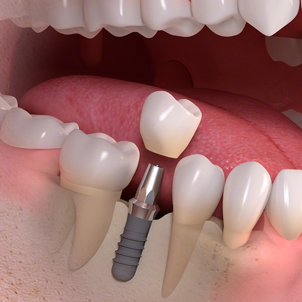 Single Dental Implant in Widnes Cheshire