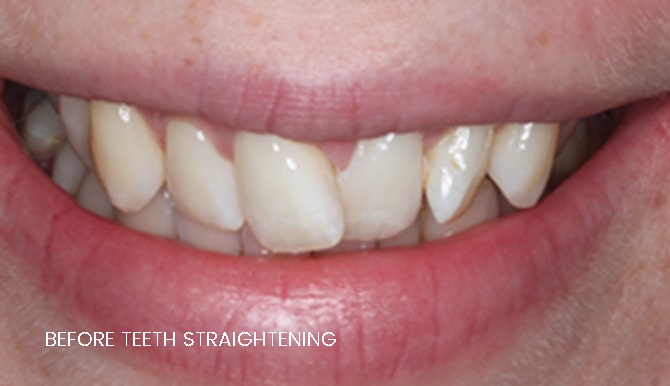 teeth striaghtening results in widnes