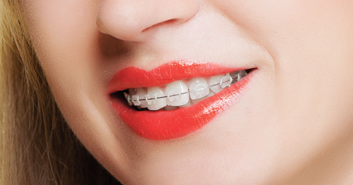 clear braces in widnes results