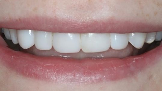 Hannah's Smile Makeover at cosmentic dentist Peelhouse Dental Care in Widnes Cheshire