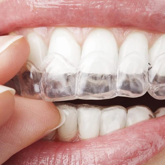invisalign-clear-braces-warrington